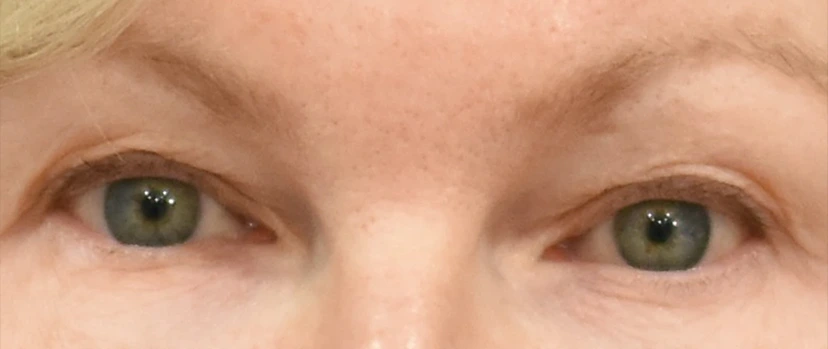 Eyelid Surgery Patient 13 Set 1 Before